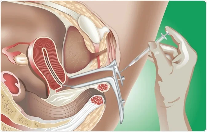 demonstration cartoon of IUI procedure
